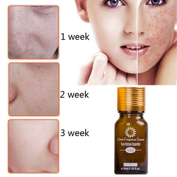 Acne Scar Removal Oil – Natural Skin Brightening, Dark Spot Remover & Stretch Marks Treatment - Image 3