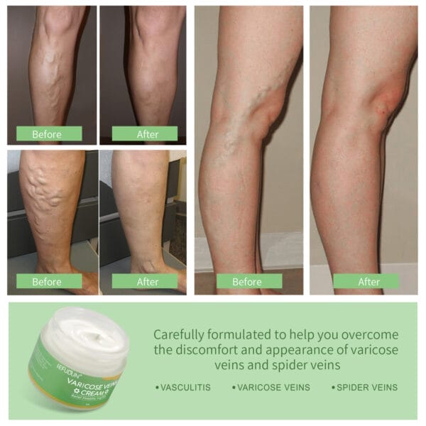 Vein Cream Red Blood Streaks Repair Earthworm Leg Bruises Bulge Relief Pain Safflower Skin care lotion Varicose Cream - Image 4