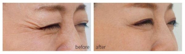 Household facial mask photon acne rejuvenation instrument - Image 7