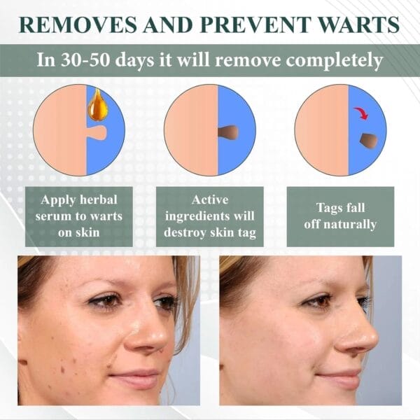 Top 10 Mole Removal Gels – Effective Spot Removal Treatment & Hydrating Body Care Kit - Image 2