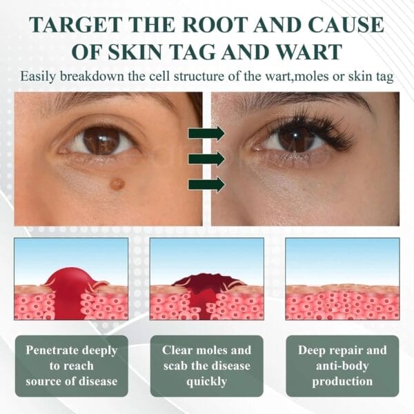Top 10 Mole Removal Gels – Effective Spot Removal Treatment & Hydrating Body Care Kit - Image 5